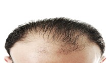 Acell + PRP Saç Dökülme Tedavisi